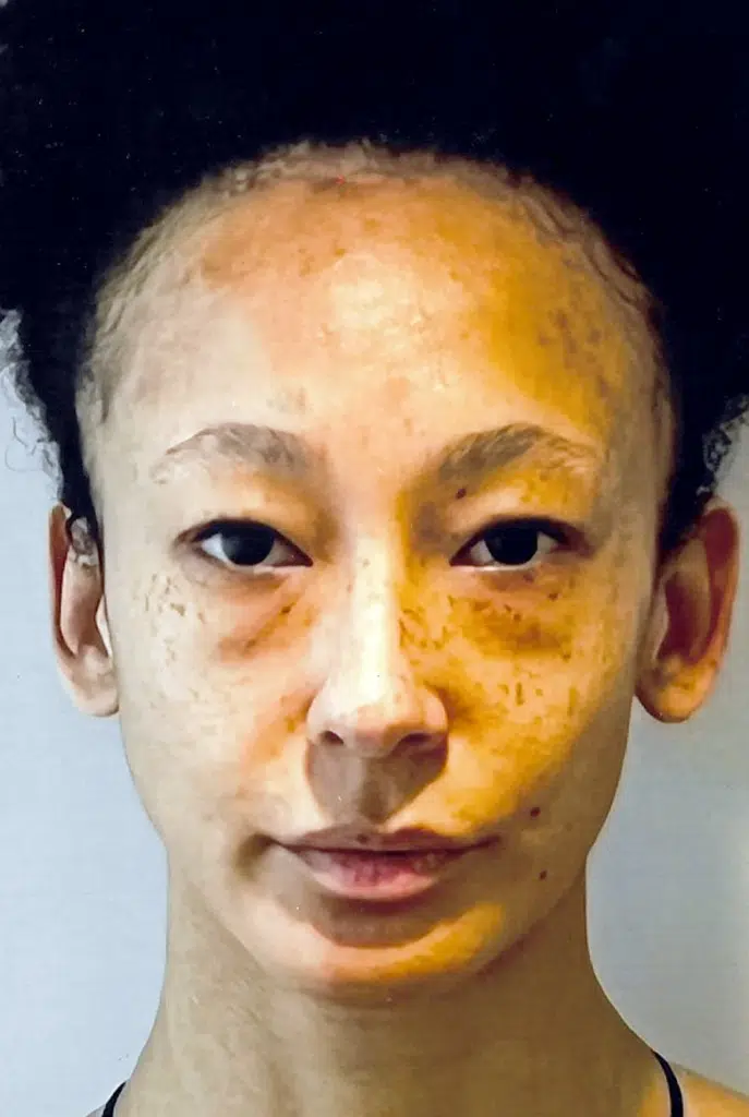 A woman with brown spots on her face.